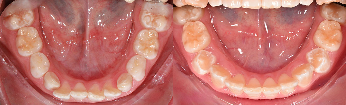 Детские элайнеры