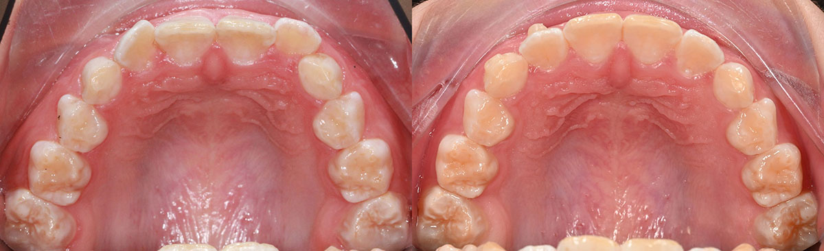 Детские элайнеры