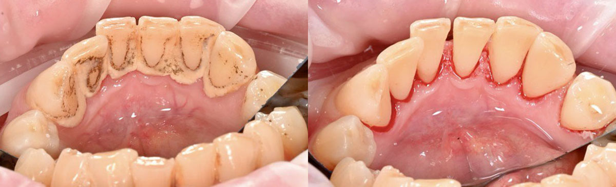 Эстетическая реставрация зубов