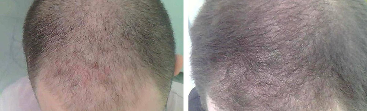 Комплексная диагностика и лечение выпадения волос (трихология)