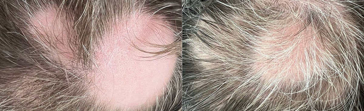 Комплексная диагностика и лечение выпадения волос (трихология)