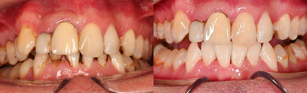 Комплексная профессиональная гигиена полости рта аппаратом AirFlow