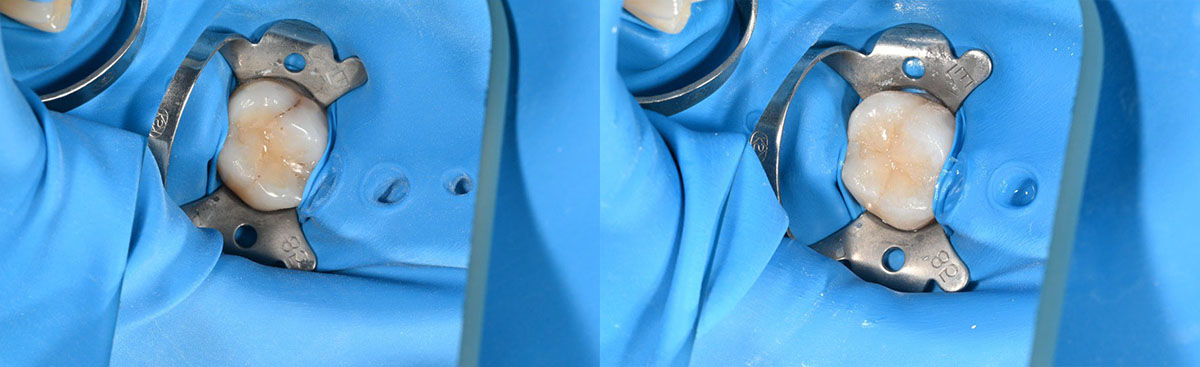 Комплексное терапевтическое и эстетическое лечение. Санация полости рта