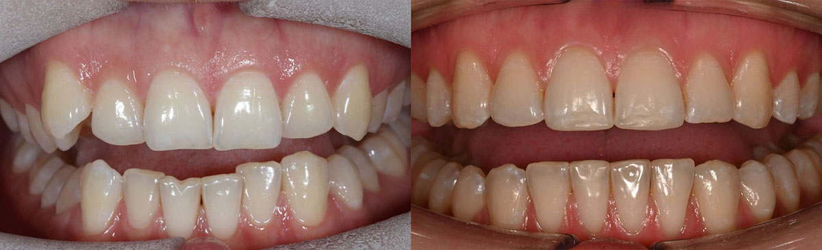 Ортодонтическое лечение. Кейс №1