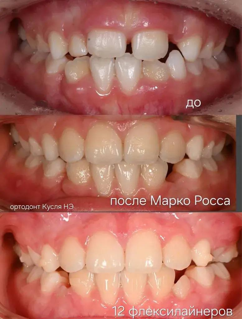 Ортодонтическое лечение у ребёнка 8 лет: аппарат Марко Роса и Флексилайн