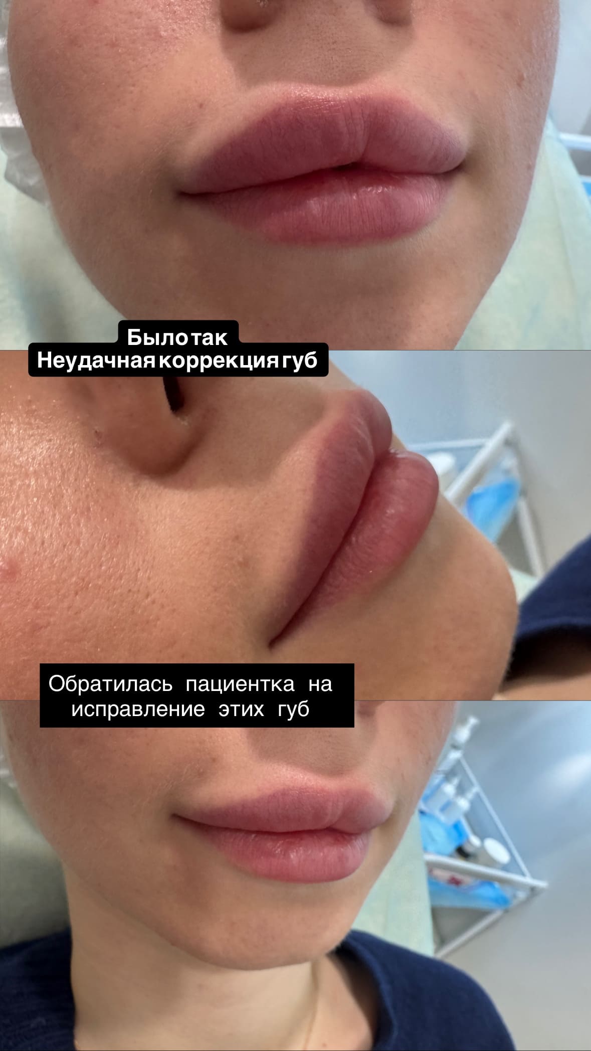 Реэстетика губ