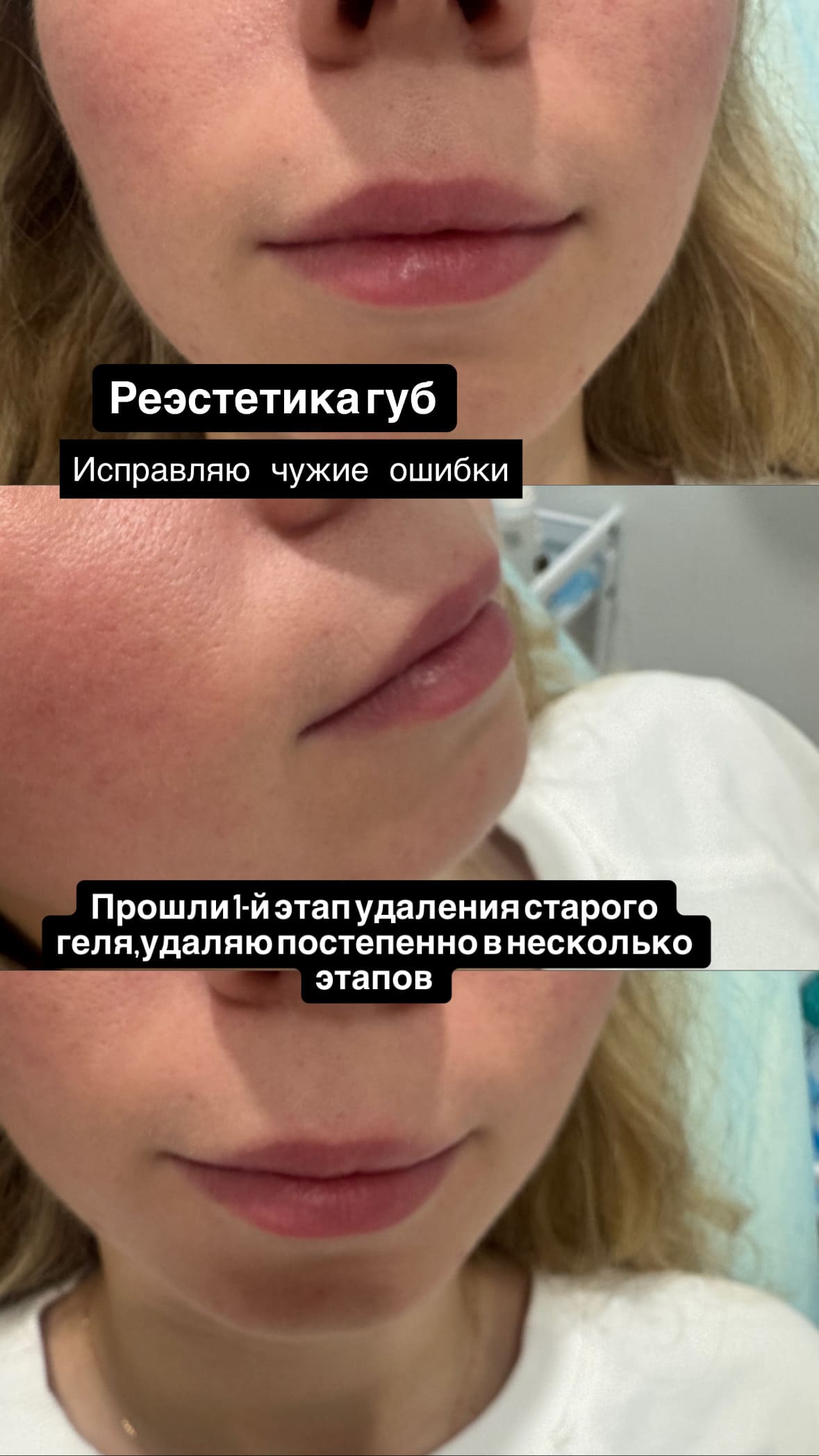 Реэстетика губ
