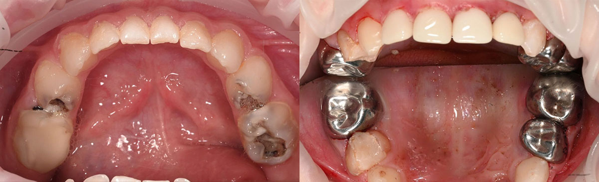 Санация полости рта малыша 4 лет в условиях общего наркоза