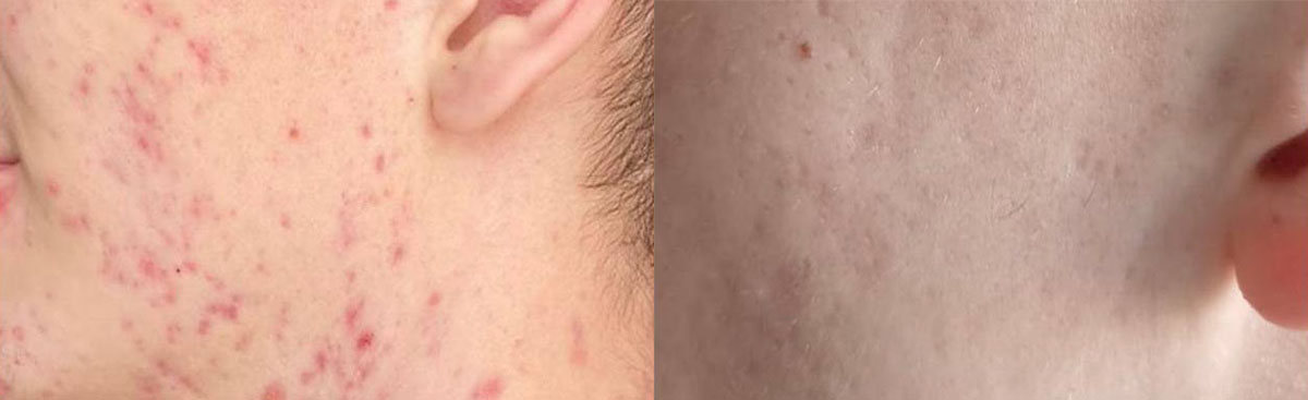 УВТ в косметологии. Лечение воспалительных элементов на лице и спине