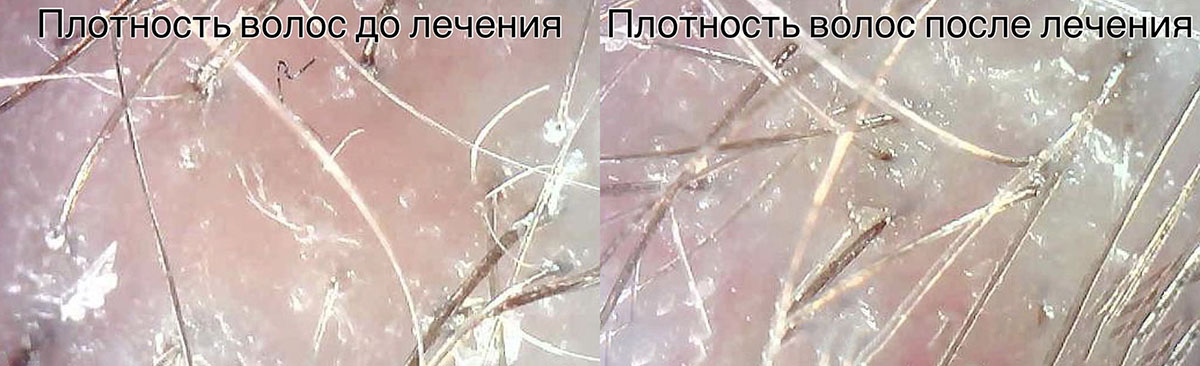 УВТ в косметологии при проблемах кожи головы 