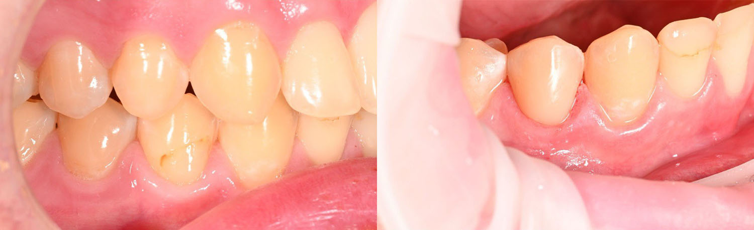 Замена пломбы