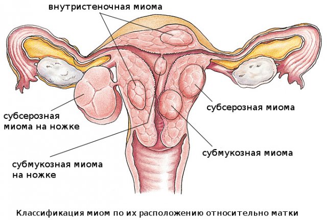 Симптомы и признаки миомы матки