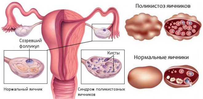 Причины синдрома поликистозных яичников у женщин