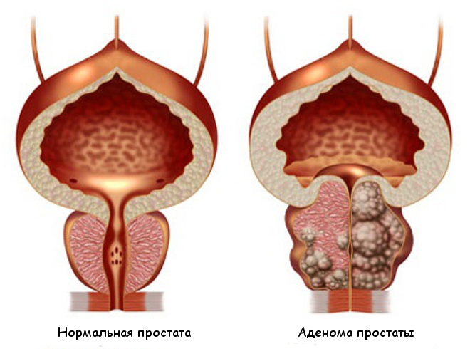 adenoma de prostata tratament)
